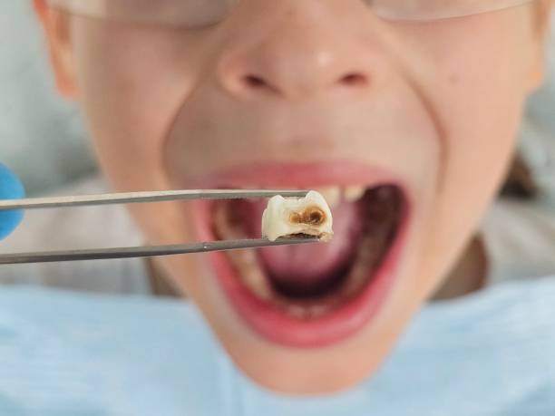 Best Emergency Root Canal Treatment in Webberville, MI